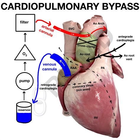 Cardiopulmonary Bypass