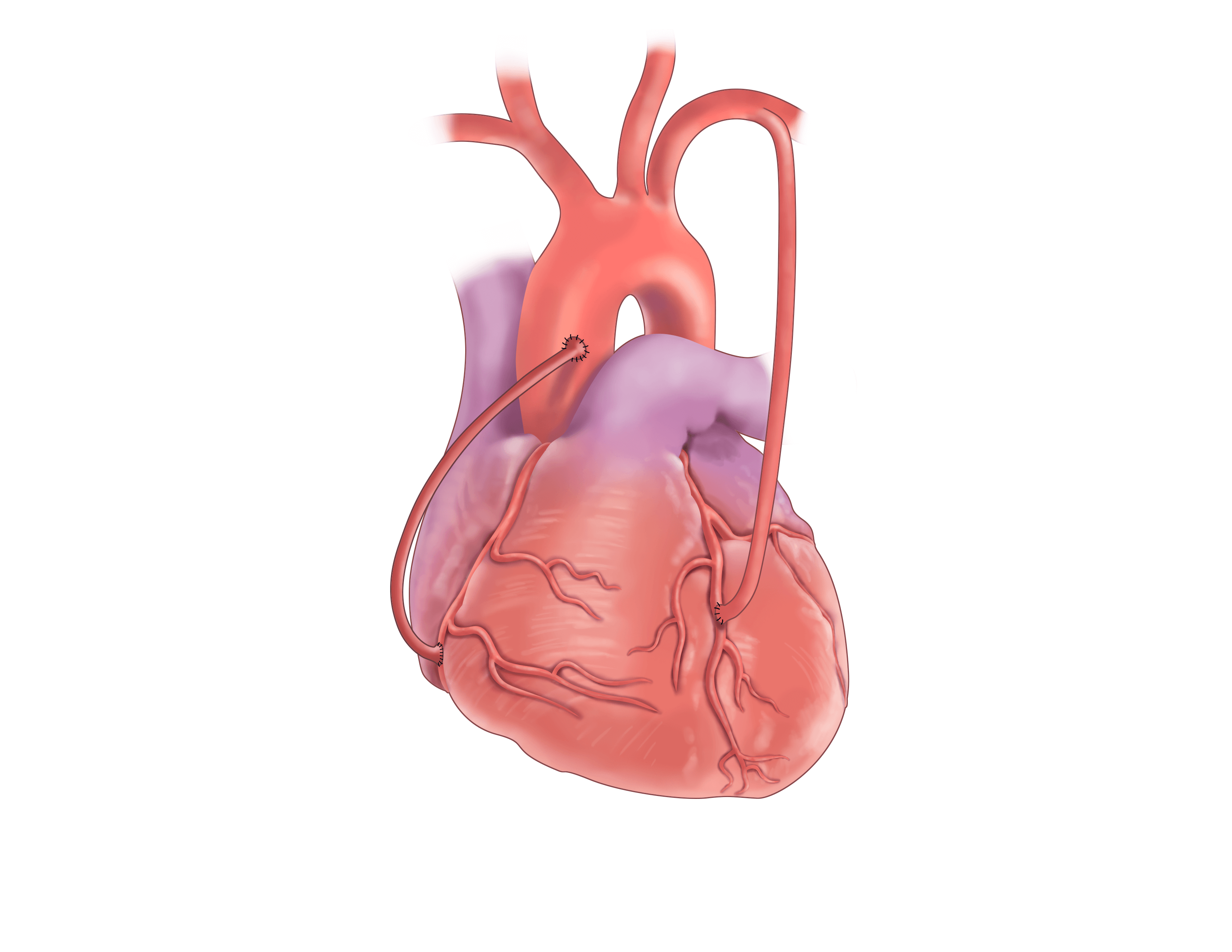 Coronary Artery Bypass Surgery Circulation