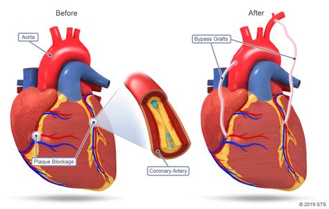 Heart Bypass Surgery