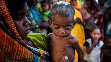 Malnutrition India News Report